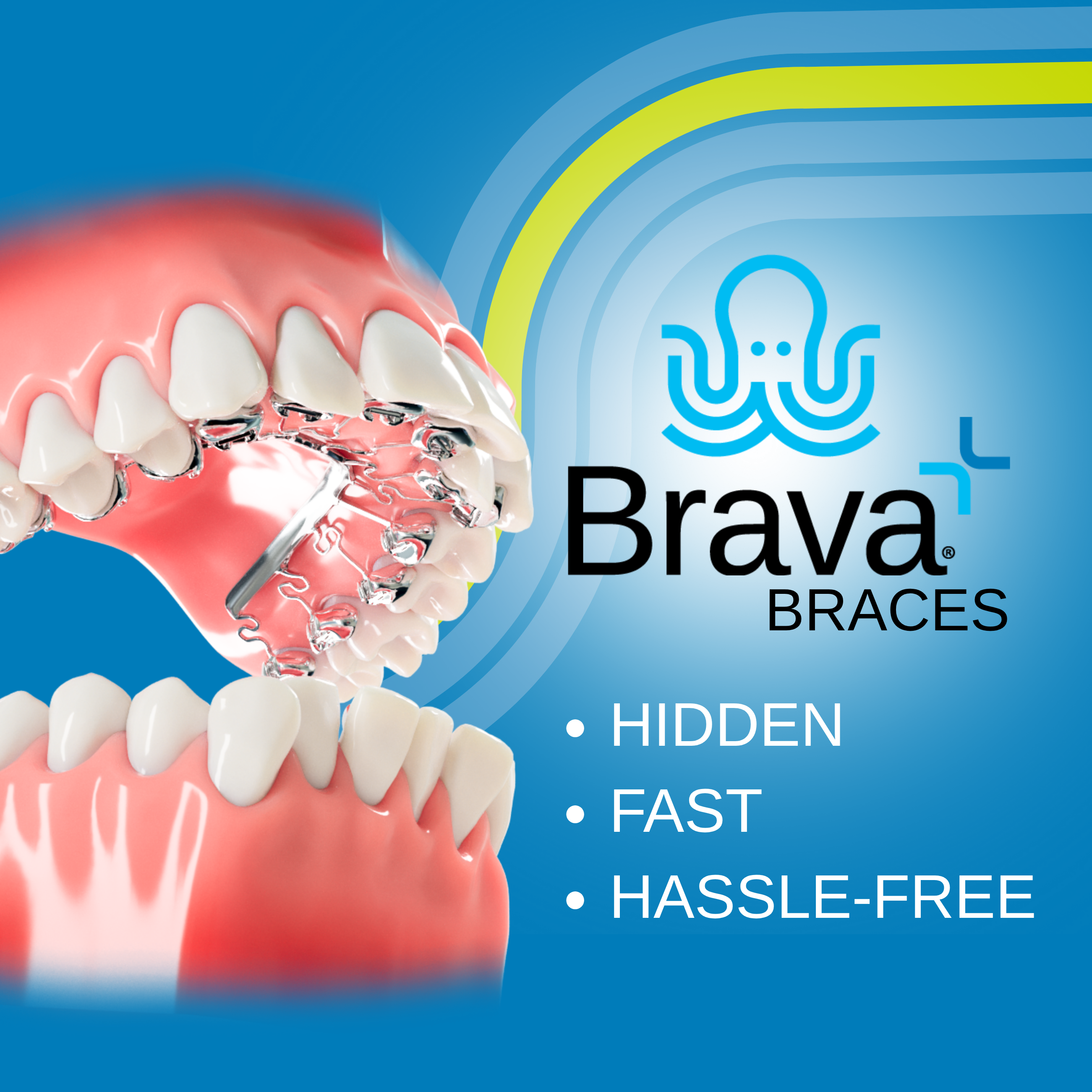 盛岡（盛岡市）の歯医者、医療法人啓仁会 栃内歯科医院の、次世代の舌側矯正システム「Brava（ブラーバ）」