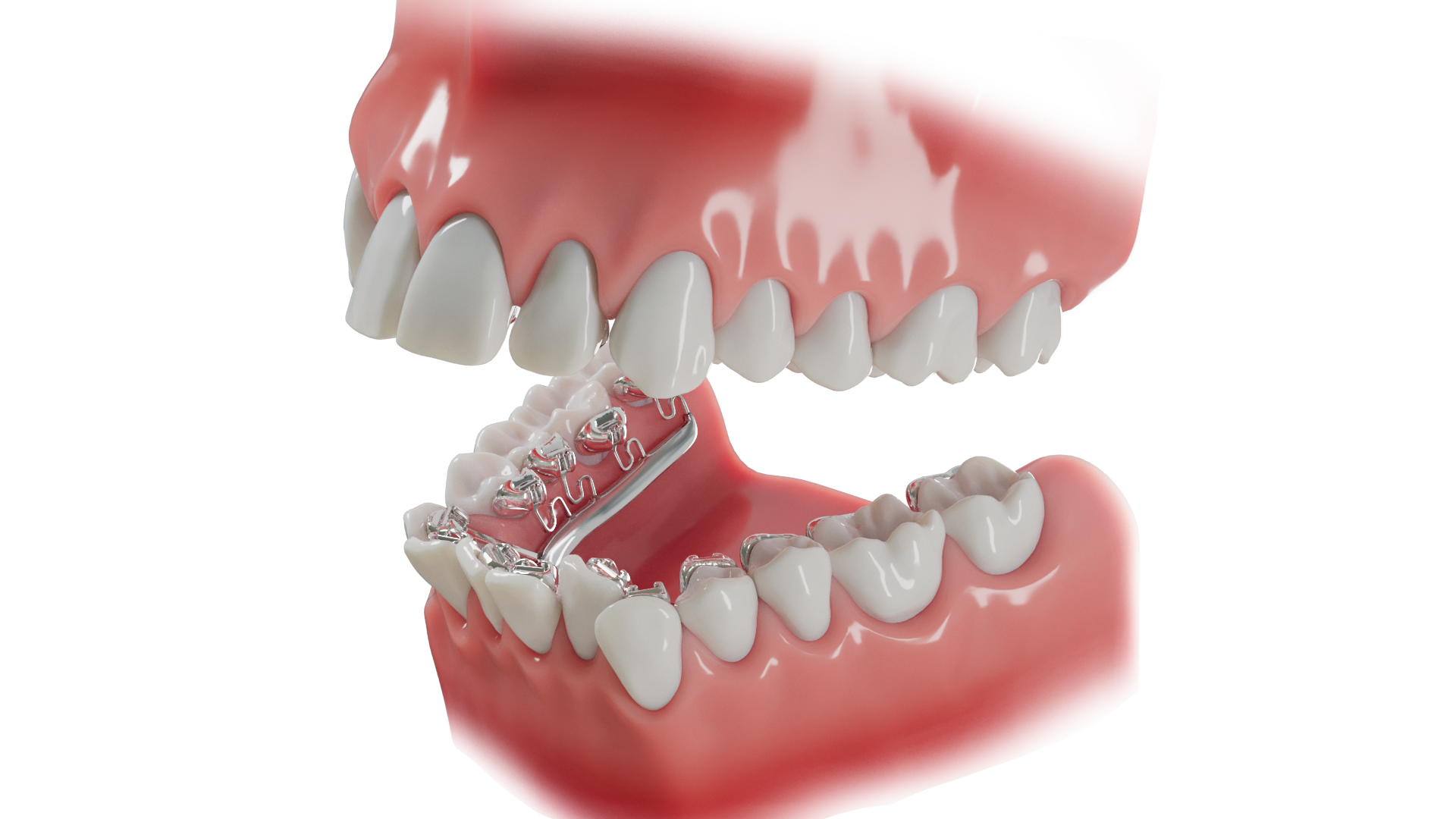 盛岡（盛岡市）の歯医者、医療法人啓仁会 栃内歯科医院の、次世代の舌側矯正システム「Brava（ブラーバ）」