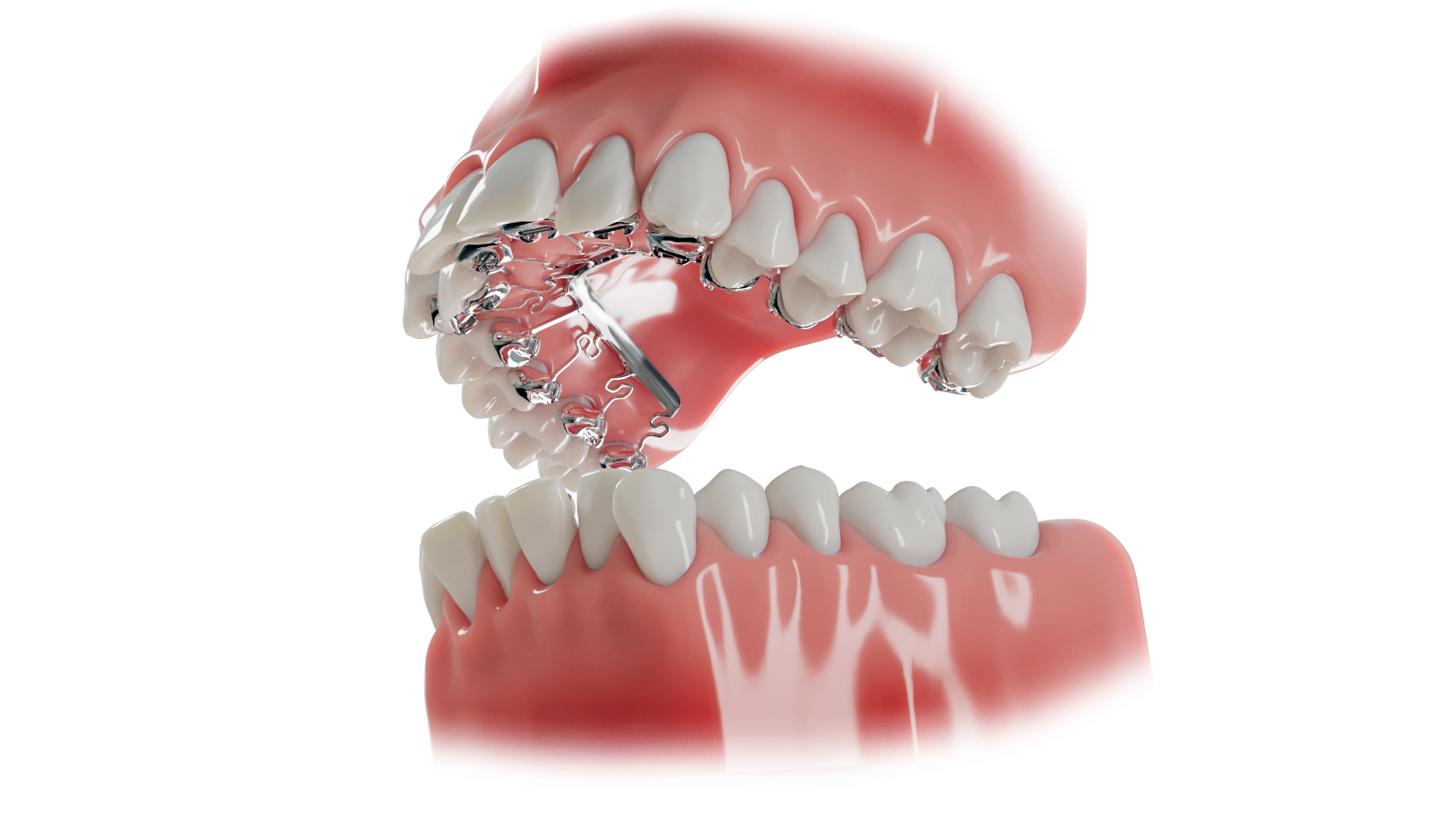 盛岡（盛岡市）の歯医者、医療法人啓仁会 栃内歯科医院の、次世代の舌側矯正システム「Brava（ブラーバ）」