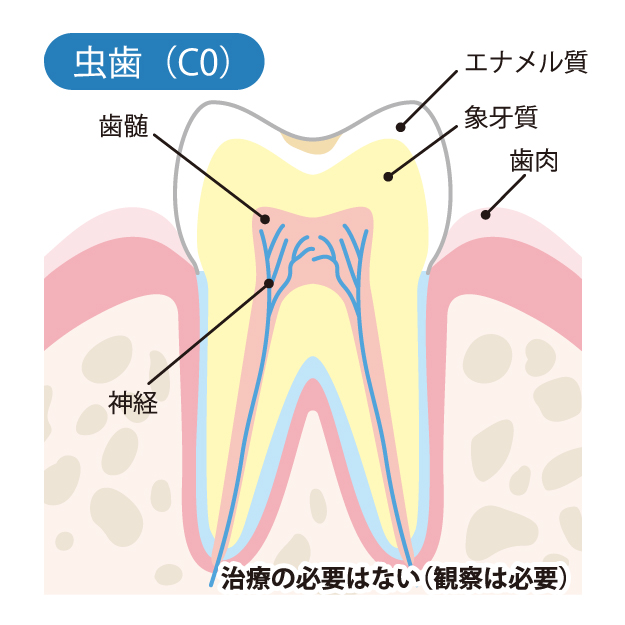 盛岡(盛岡市)の歯医者、医療法人啓仁会 栃内歯科医院のむし歯治療