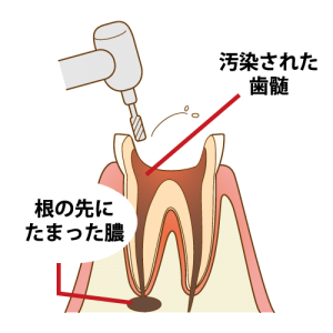 盛岡（盛岡市）の歯医者、医療法人啓仁会 栃内歯科医院の根管治療の流れ