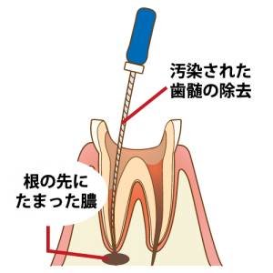 盛岡（盛岡市）の歯医者、医療法人啓仁会 栃内歯科医院の根管治療の流れ