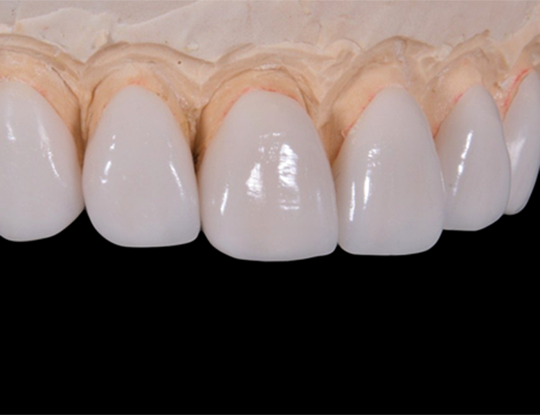 オールセラミック - 盛岡（盛岡市）の歯医者、医療法人啓仁会 栃内歯科医院