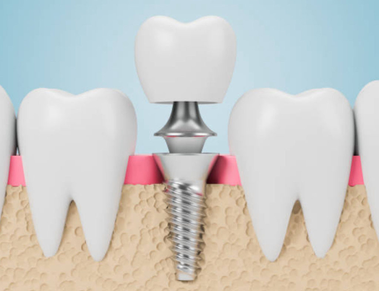 インプラント - 盛岡（盛岡市）の歯医者、医療法人啓仁会 栃内歯科医院