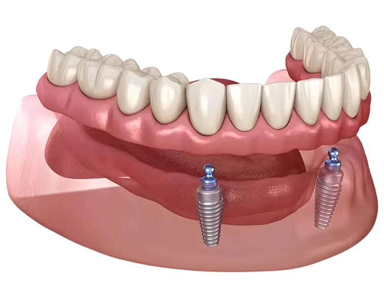 インプラントオーバデンチャー - 盛岡（盛岡市）の歯医者、医療法人