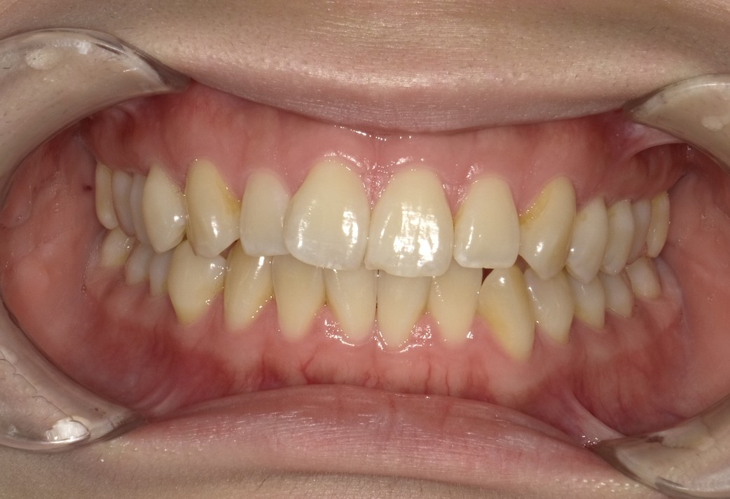 盛岡（盛岡市）の歯医者、医療法人啓仁会 栃内歯科医院のラミネートべニア症例