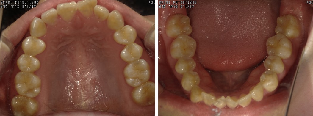 盛岡（盛岡市）の歯医者、医療法人啓仁会 栃内歯科医院のラミネートべニア症例