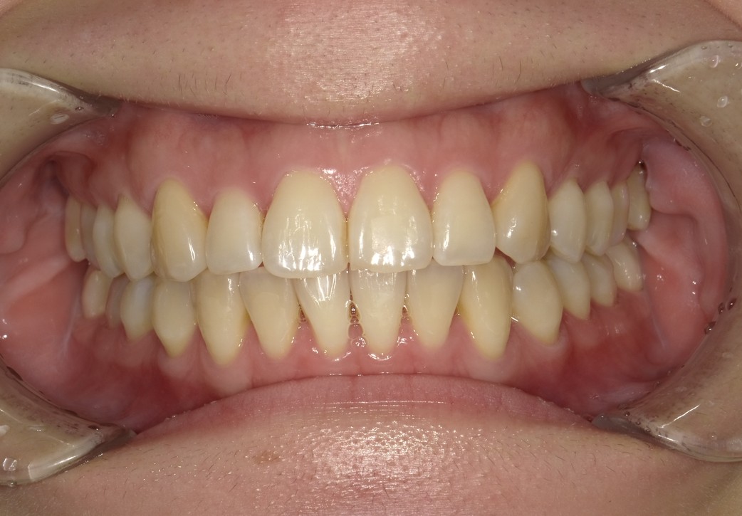 盛岡（盛岡市）の歯医者、医療法人啓仁会 栃内歯科医院のラミネートべニア症例