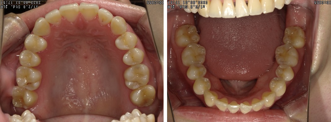 盛岡（盛岡市）の歯医者、医療法人啓仁会 栃内歯科医院のラミネートべニア症例
