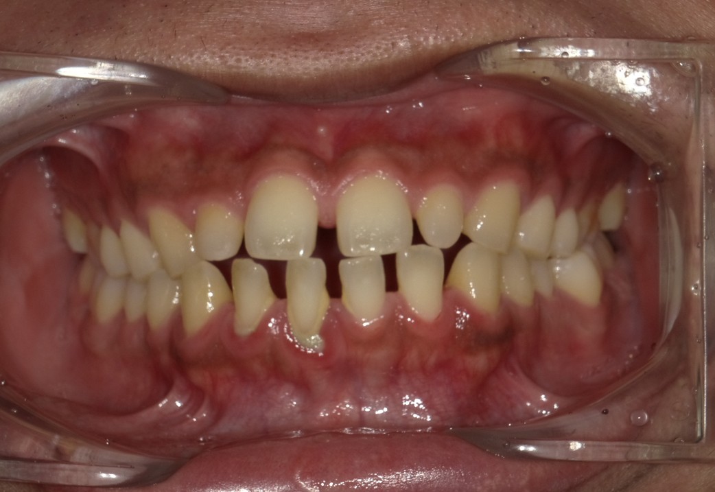 盛岡（盛岡市）の歯医者、医療法人啓仁会 栃内歯科医院の矯正歯科症例