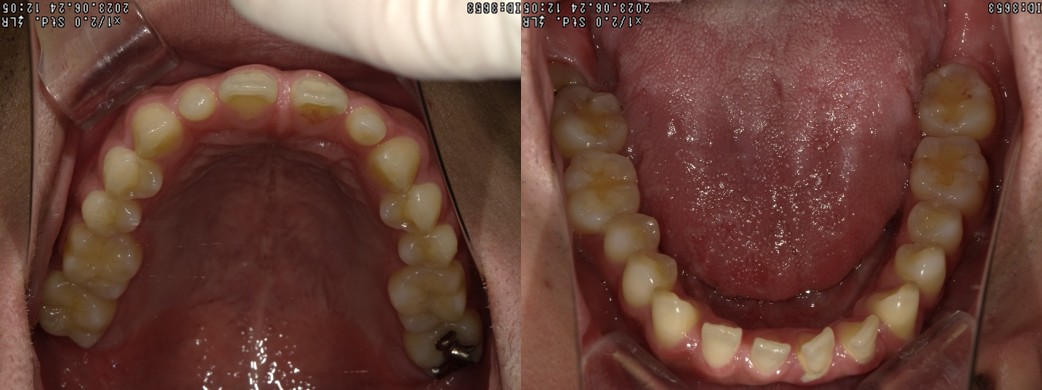 盛岡（盛岡市）の歯医者、医療法人啓仁会 栃内歯科医院の矯正歯科症例