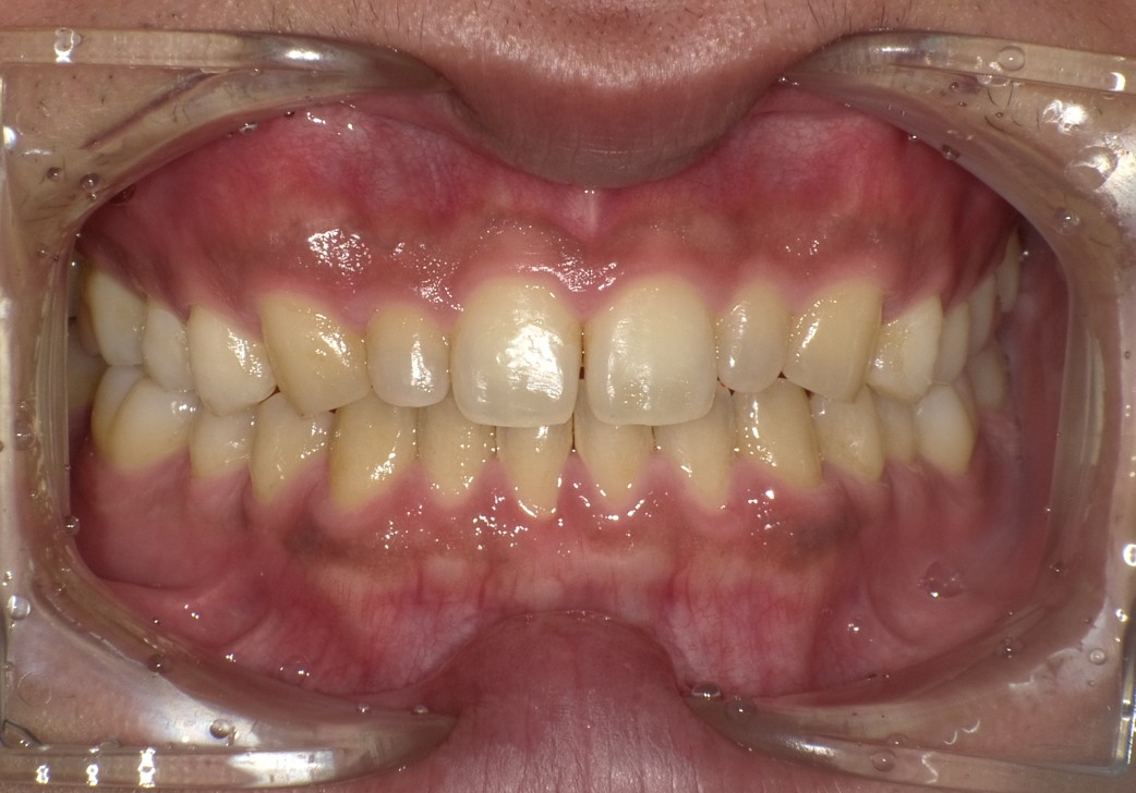 盛岡（盛岡市）の歯医者、医療法人啓仁会 栃内歯科医院の矯正歯科症例