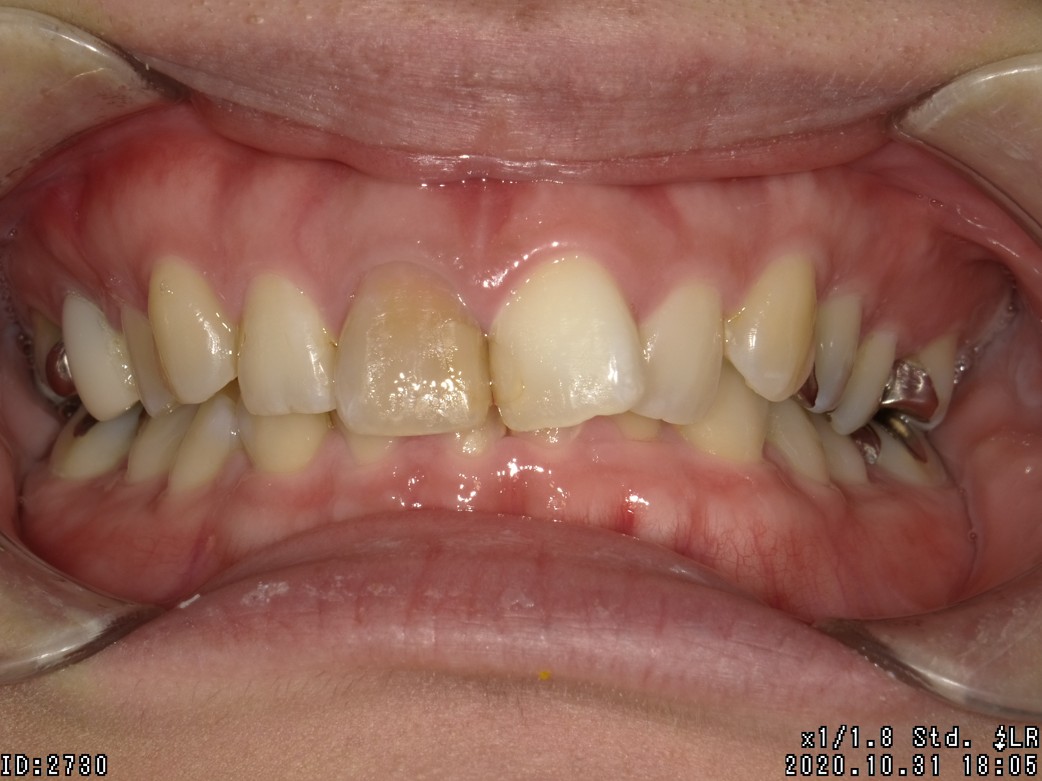 盛岡（盛岡市）の歯医者、医療法人啓仁会 栃内歯科医院の矯正歯科症例