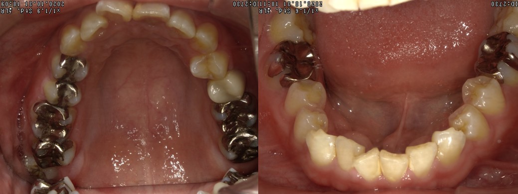 盛岡（盛岡市）の歯医者、医療法人啓仁会 栃内歯科医院の矯正歯科症例