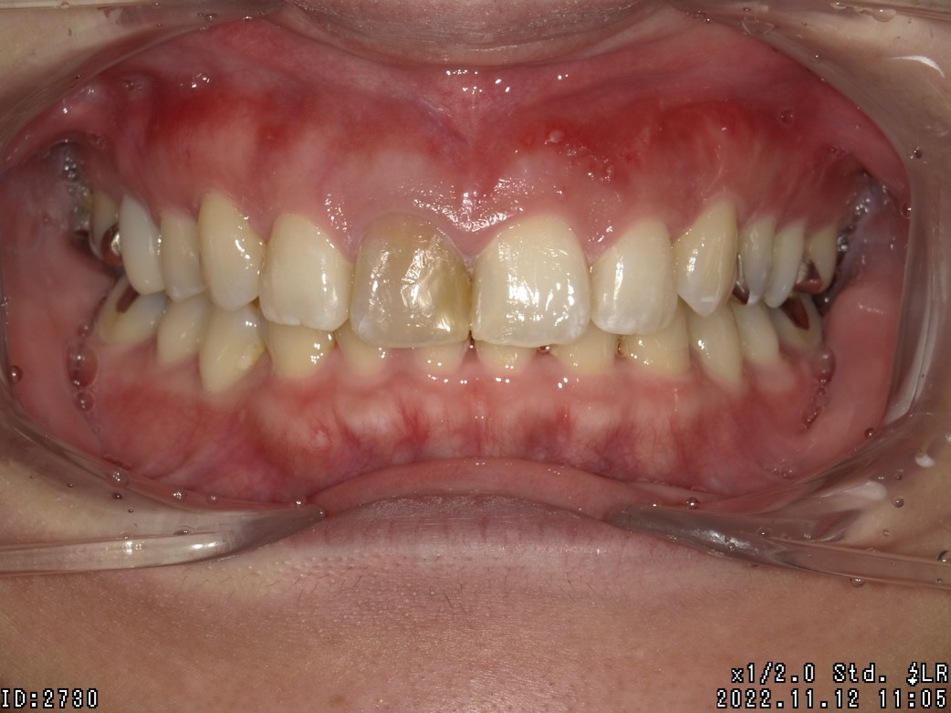 盛岡（盛岡市）の歯医者、医療法人啓仁会 栃内歯科医院の矯正歯科症例