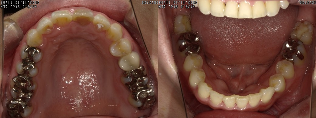 盛岡（盛岡市）の歯医者、医療法人啓仁会 栃内歯科医院の矯正歯科症例