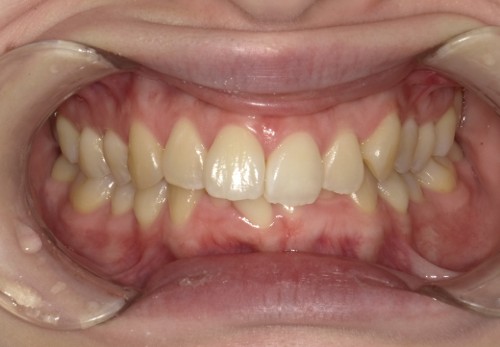 盛岡（盛岡市）の歯医者、医療法人啓仁会 栃内歯科医院の矯正歯科症例