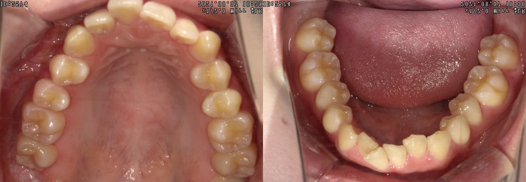 盛岡(盛岡市)の歯医者、医療法人啓仁会 栃内歯科医院の矯正歯科症例