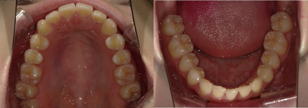 盛岡(盛岡市)の歯医者、医療法人啓仁会 栃内歯科医院の矯正歯科症例