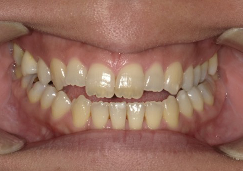 盛岡（盛岡市）の歯医者、医療法人啓仁会 栃内歯科医院の矯正歯科症例