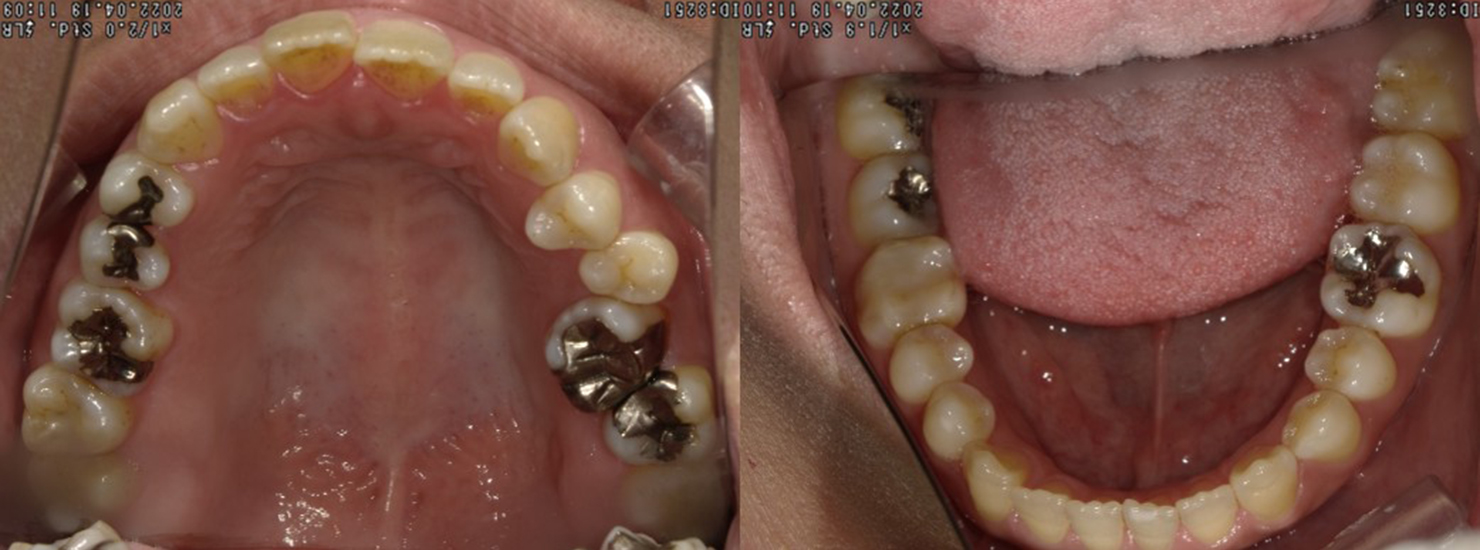 盛岡(盛岡市)の歯医者、医療法人啓仁会 栃内歯科医院の矯正歯科症例