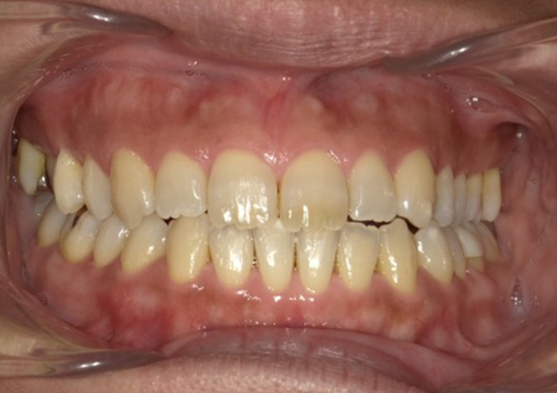 盛岡（盛岡市）の歯医者、医療法人啓仁会 栃内歯科医院の矯正歯科症例