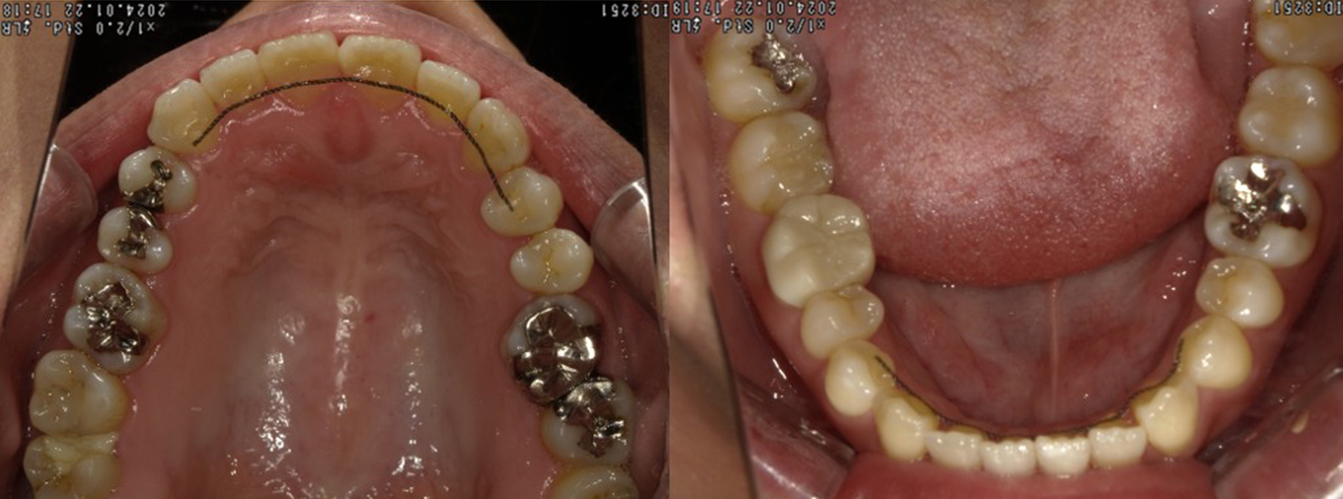 盛岡(盛岡市)の歯医者、医療法人啓仁会 栃内歯科医院の矯正歯科症例