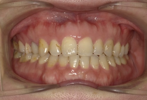 盛岡（盛岡市）の歯医者、医療法人啓仁会 栃内歯科医院の矯正歯科症例