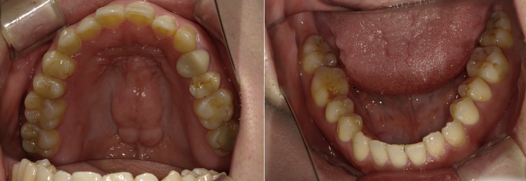 盛岡(盛岡市)の歯医者、医療法人啓仁会 栃内歯科医院の矯正歯科症例