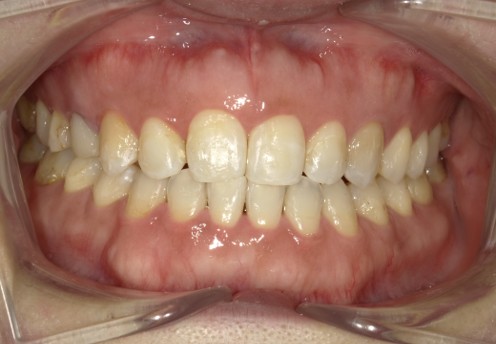 盛岡（盛岡市）の歯医者、医療法人啓仁会 栃内歯科医院の矯正歯科症例