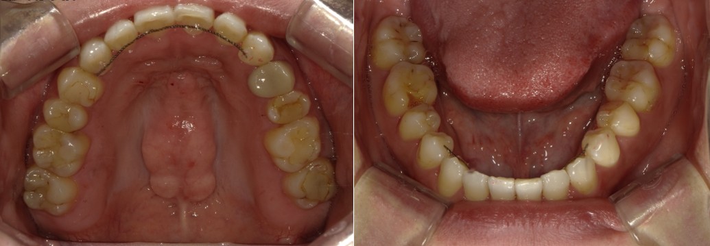 盛岡(盛岡市)の歯医者、医療法人啓仁会 栃内歯科医院の矯正歯科症例