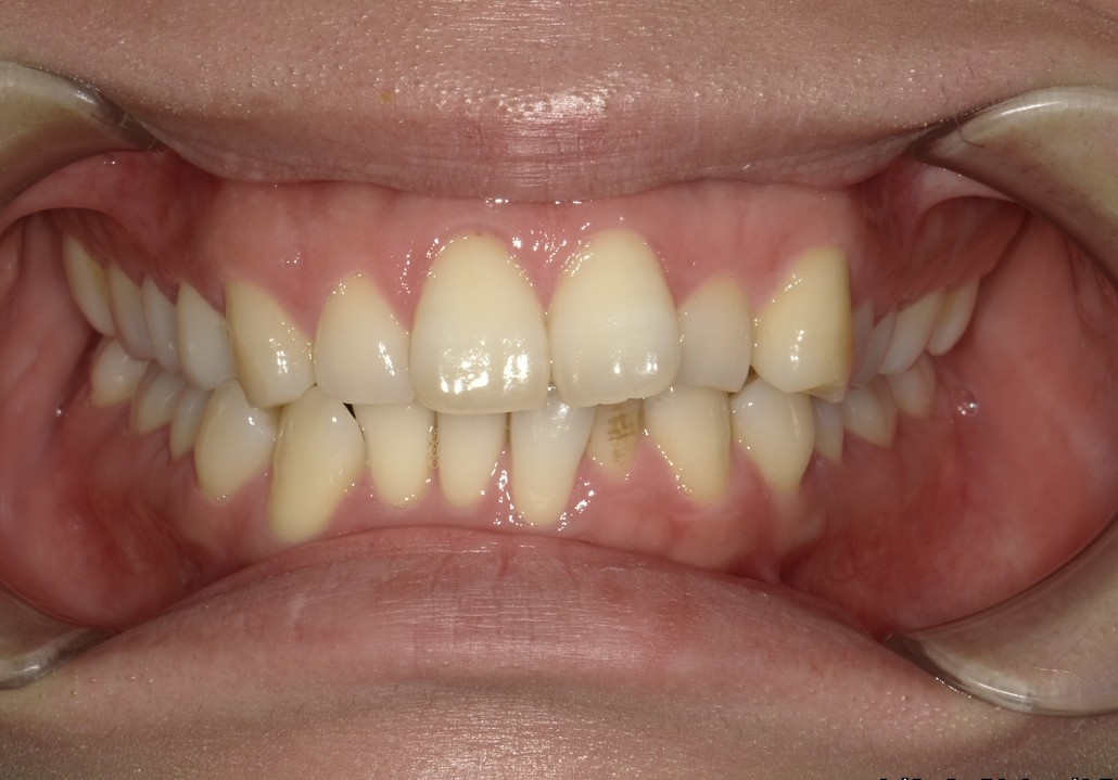 盛岡（盛岡市）の歯医者、医療法人啓仁会 栃内歯科医院の矯正歯科症例