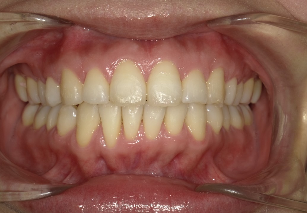 盛岡（盛岡市）の歯医者、医療法人啓仁会 栃内歯科医院の矯正歯科症例