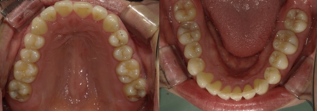 盛岡（盛岡市）の歯医者、医療法人啓仁会 栃内歯科医院の矯正歯科症例