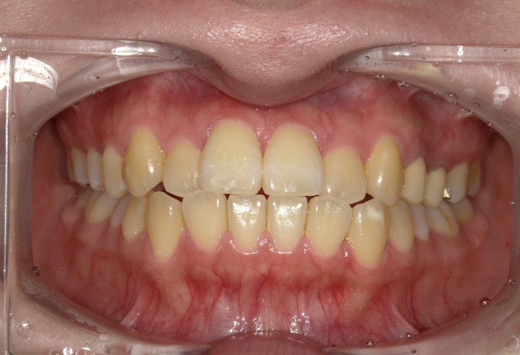 盛岡（盛岡市）の歯医者、医療法人啓仁会 栃内歯科医院の矯正歯科症例