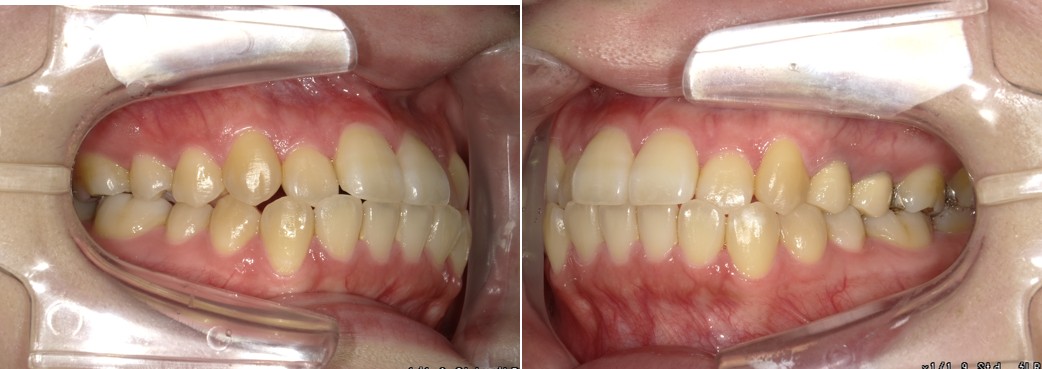 盛岡（盛岡市）の歯医者、医療法人啓仁会 栃内歯科医院の矯正歯科症例