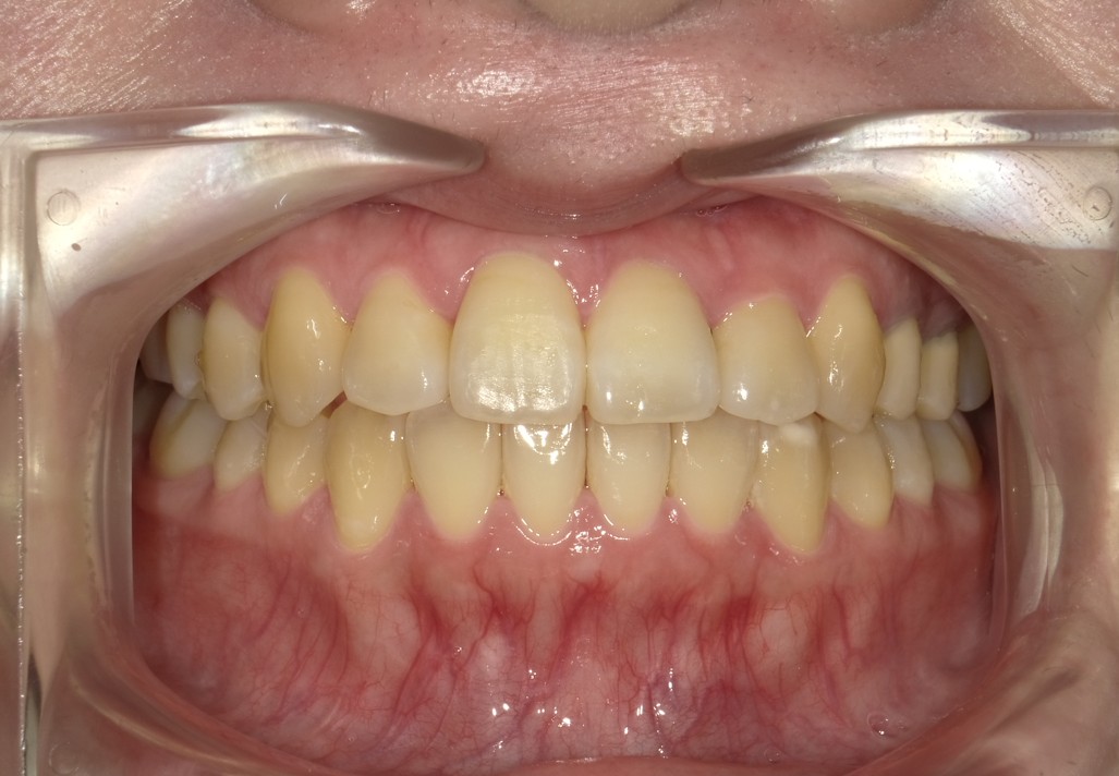 盛岡（盛岡市）の歯医者、医療法人啓仁会 栃内歯科医院の矯正歯科症例