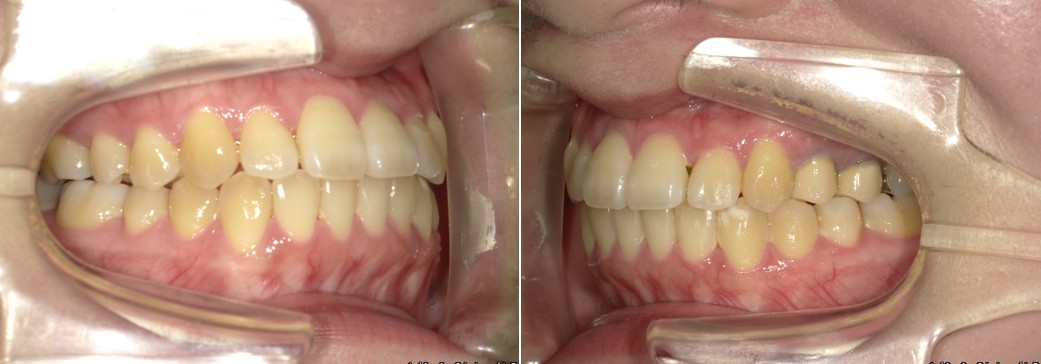 盛岡（盛岡市）の歯医者、医療法人啓仁会 栃内歯科医院の矯正歯科症例