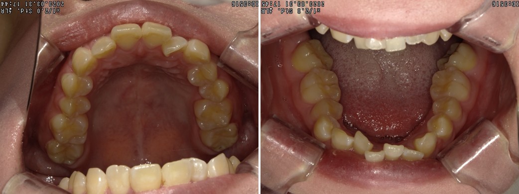 盛岡（盛岡市）の歯医者、医療法人啓仁会 栃内歯科医院の矯正歯科症例