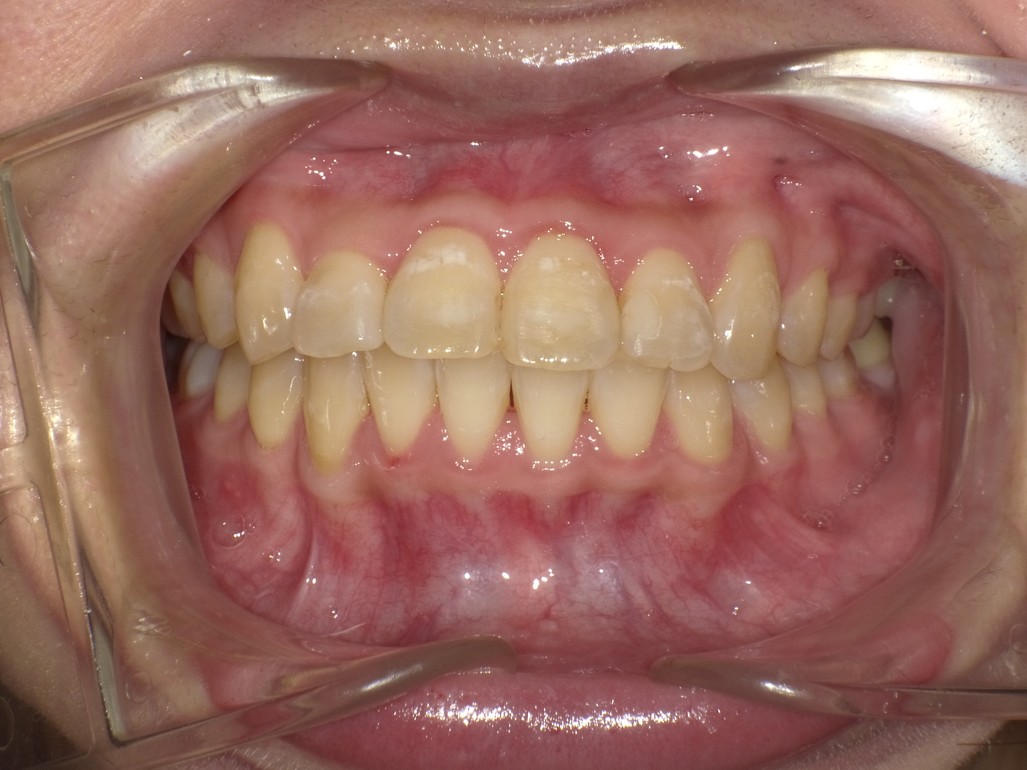 盛岡（盛岡市）の歯医者、医療法人啓仁会 栃内歯科医院の矯正歯科症例