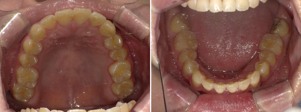盛岡（盛岡市）の歯医者、医療法人啓仁会 栃内歯科医院の矯正歯科症例