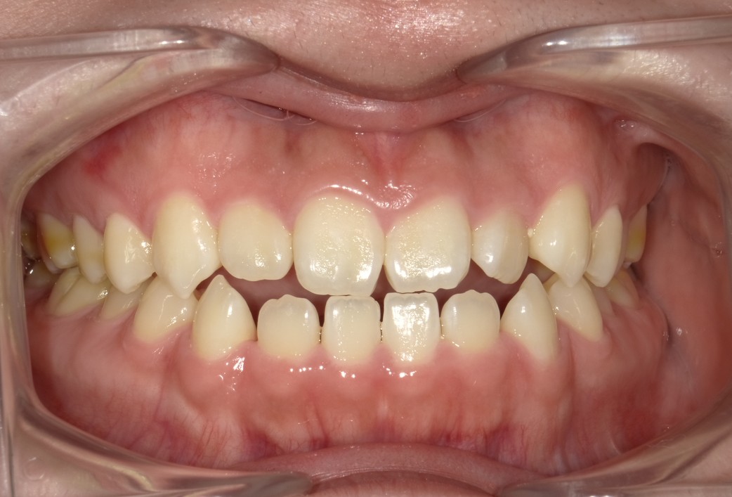 盛岡（盛岡市）の歯医者、医療法人啓仁会 栃内歯科医院の矯正歯科症例