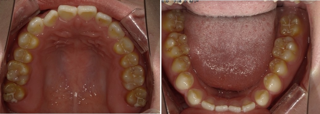 盛岡（盛岡市）の歯医者、医療法人啓仁会 栃内歯科医院の矯正歯科症例