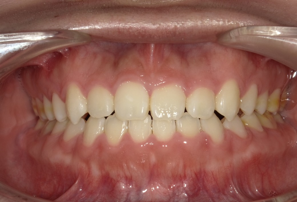 盛岡（盛岡市）の歯医者、医療法人啓仁会 栃内歯科医院の矯正歯科症例