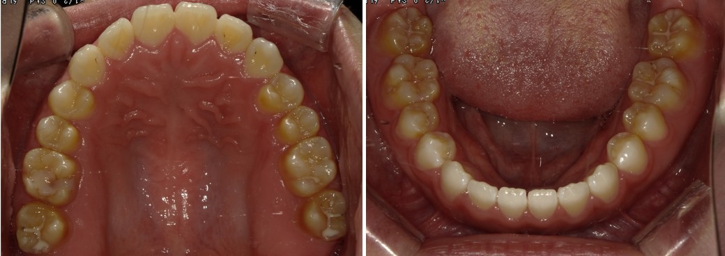 盛岡（盛岡市）の歯医者、医療法人啓仁会 栃内歯科医院の矯正歯科症例