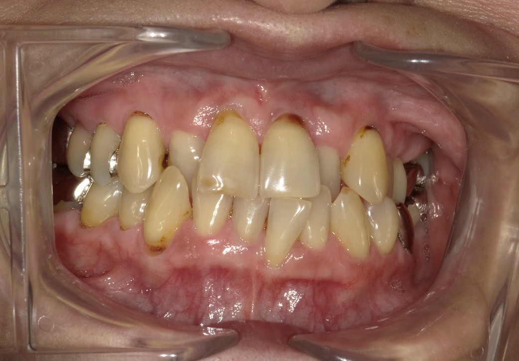 盛岡（盛岡市）の歯医者、医療法人啓仁会 栃内歯科医院の矯正歯科症例