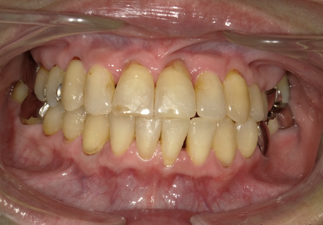 盛岡（盛岡市）の歯医者、医療法人啓仁会 栃内歯科医院の矯正歯科症例