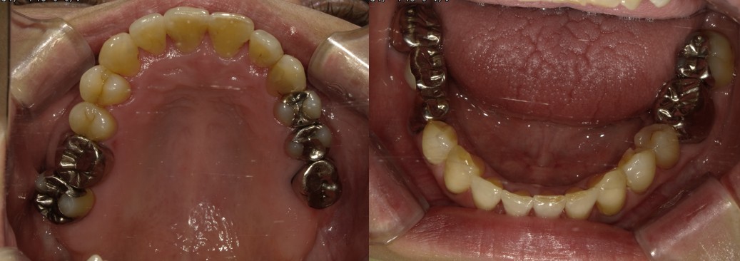 盛岡(盛岡市)の歯医者、医療法人啓仁会 栃内歯科医院の矯正歯科症例