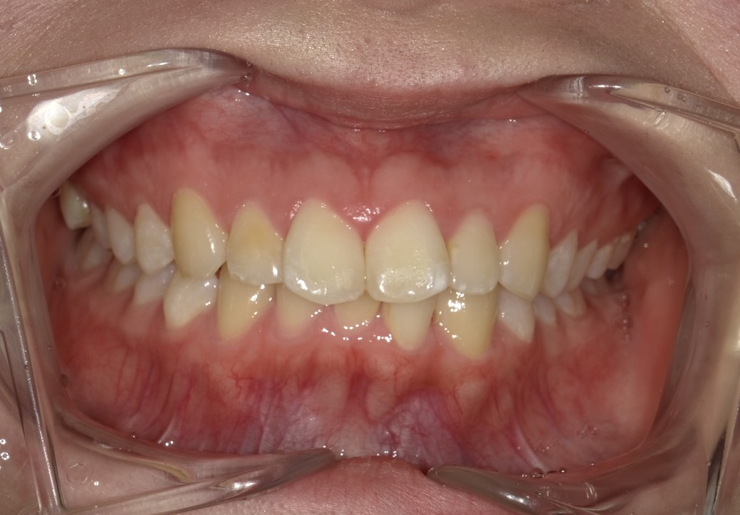 盛岡（盛岡市）の歯医者、医療法人啓仁会 栃内歯科医院の矯正歯科症例