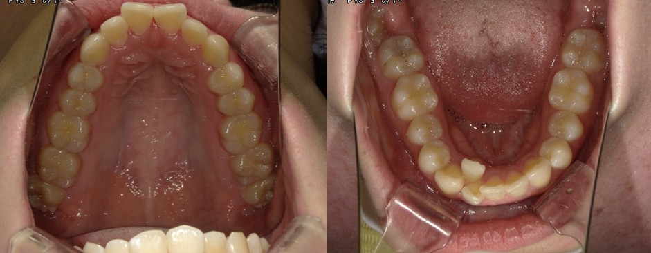 盛岡(盛岡市)の歯医者、医療法人啓仁会 栃内歯科医院の矯正歯科症例